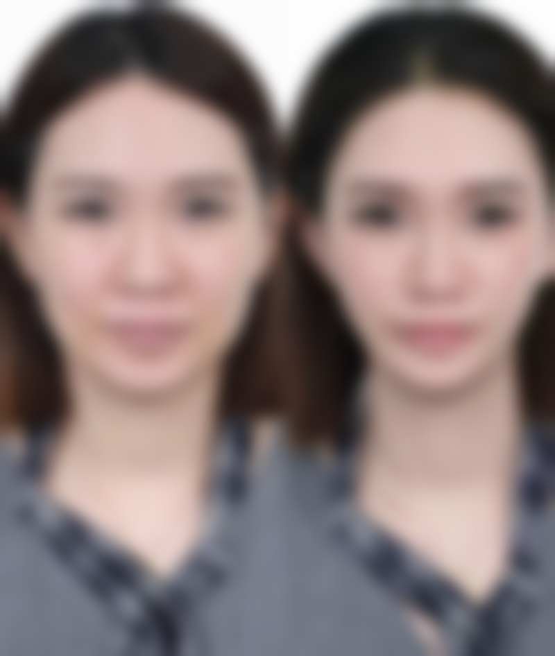 做了双眼皮以后眼皮松弛的原因——手术操作与个体差异影响