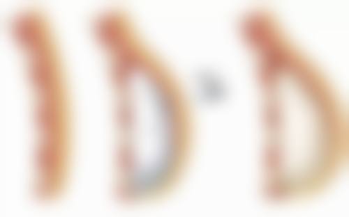 做假体隆胸有没有风险？揭秘包膜挛缩、假体破裂等并发症及安全选择指南