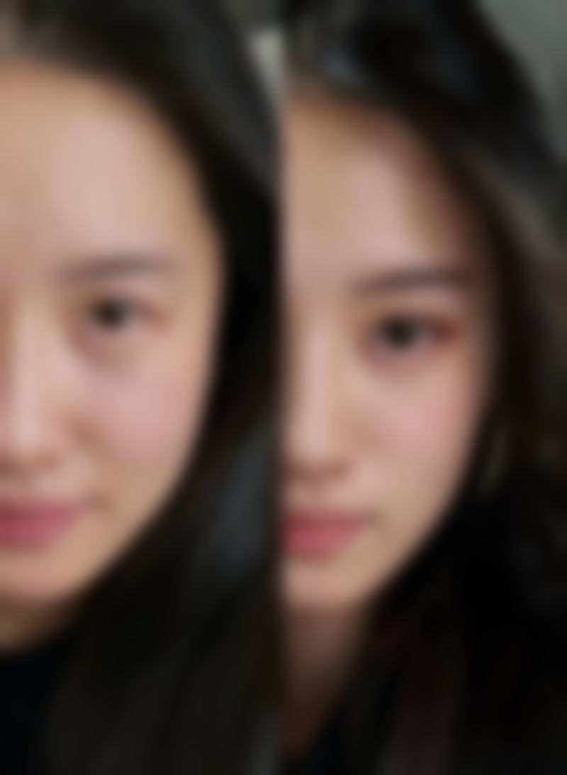 怎么样去除先天性眼袋：医院专精指导下的成长守护