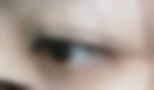 晋圣阳医生解析芦荟胶对陈旧性疤痕是否有效