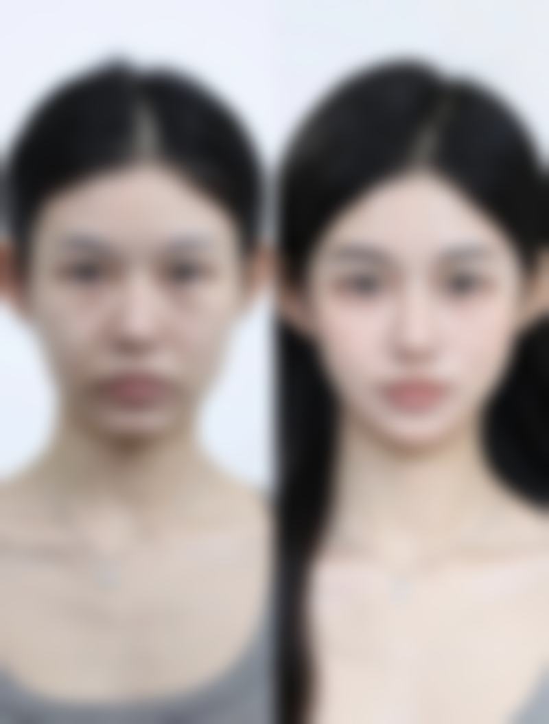 冰敷眼睛消眼袋的合理频率