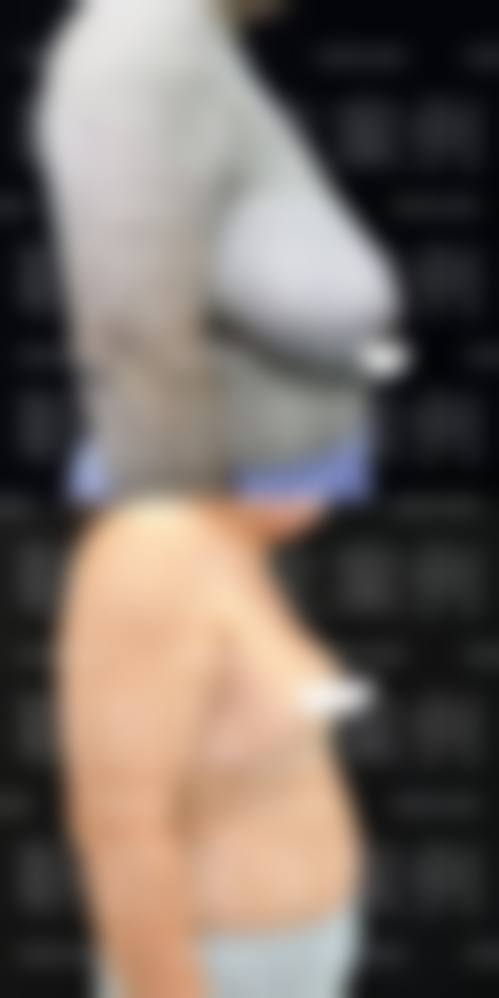 10000元左右眼部整形项目选择