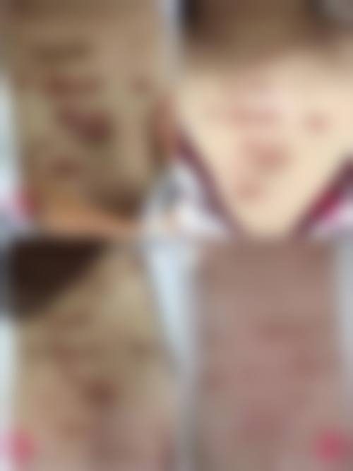 面瘫矫治