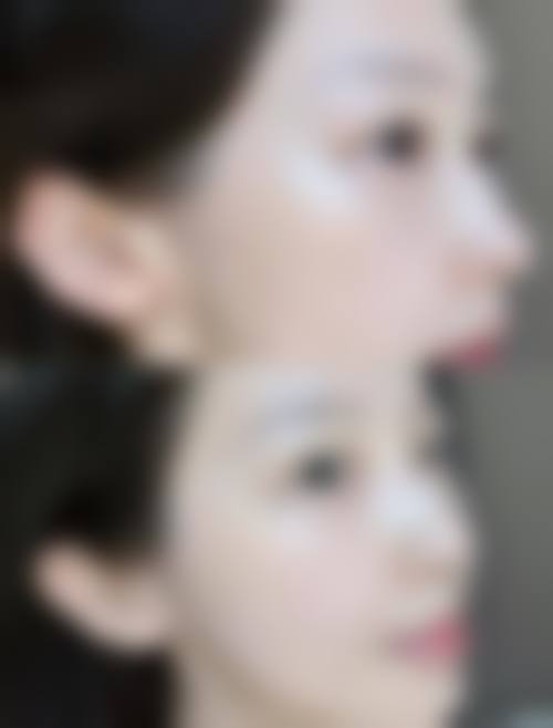 腹部除皱术