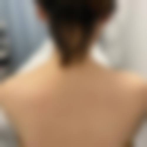 Q:面部除皱等项目的成效能维持多久?